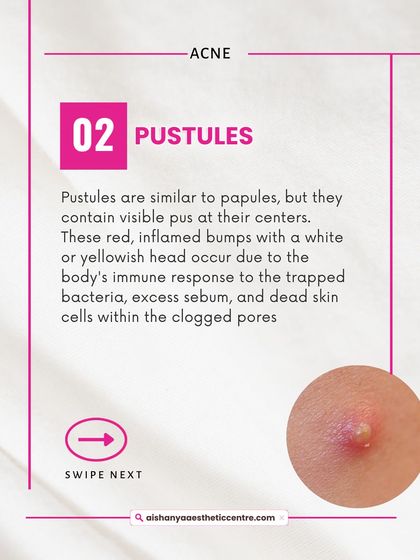 Pustules are what many people think of as a typical pimple. They are inflamed bumps with a white or yellow center of pus. It's important not to pop these to avoid scarring.