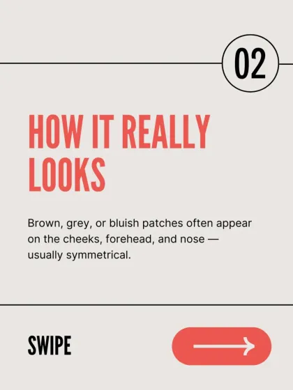 This image explains how melasma typically appears as brown, grey, or bluish patches, often symmetrically on the cheeks, forehead, and nose. Proper diagnosis is crucial for effective treatment.