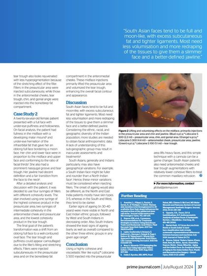 This page from my article details a case study on facial contouring. It explains the anatomical considerations and injection strategies I use to achieve a slimmer, more defined facial structure.