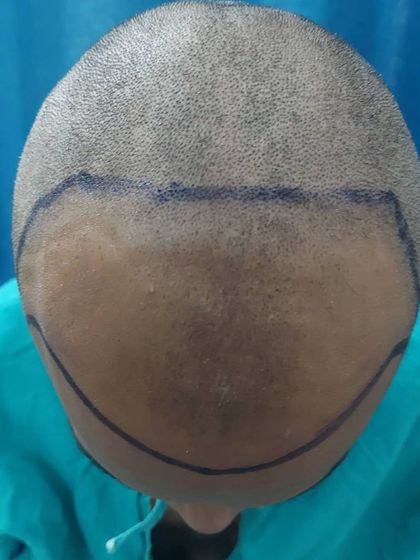 An overhead view of the scalp marked for the transplant. This shows how we map out both the hairline and the crown area to achieve balanced and comprehensive coverage.