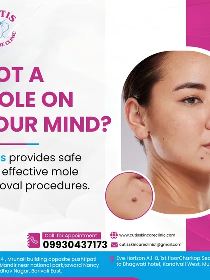 Got a mole on your mind? We provide safe and effective mole removal procedures. This image shows a close-up of a facial mole, a common concern we address with expert dermatological care for flawless results.