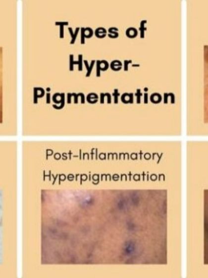 A visual guide to the common types of hyperpigmentation. Understanding whether you have sun spots, freckles, or melasma helps me create the most effective, targeted treatment plan for you.
