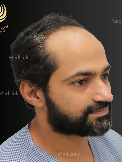 The patient's hair from the side before the procedure.