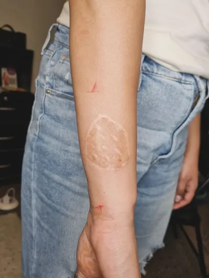 The 'before' photo showing the burn scar on the client's arm that was later concealed by the rose tattoo.