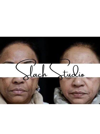 A frontal view showing the overall brightening effect and reduction of fine lines and shadows on the face.