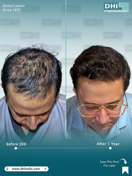 A top-down view of the same client's one-year result. This angle reveals the excellent coverage achieved on the crown and mid-scalp, showcasing the 6,856 hairs implanted using our DHI technique.
