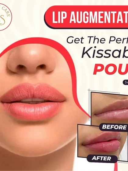Achieve the perfect pout with lip augmentation. This treatment uses hyaluronic acid fillers to add volume and shape, giving you natural-looking, kissable lips as seen in this before and after comparison.