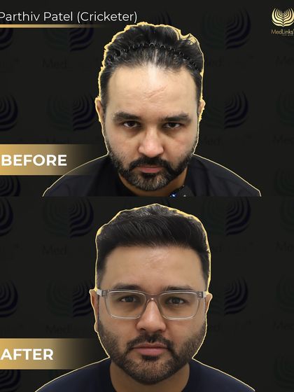 A frontal before and after of Parthiv Patel. His journey is proof that the right expertise can restore not just your hair but your confidence too.