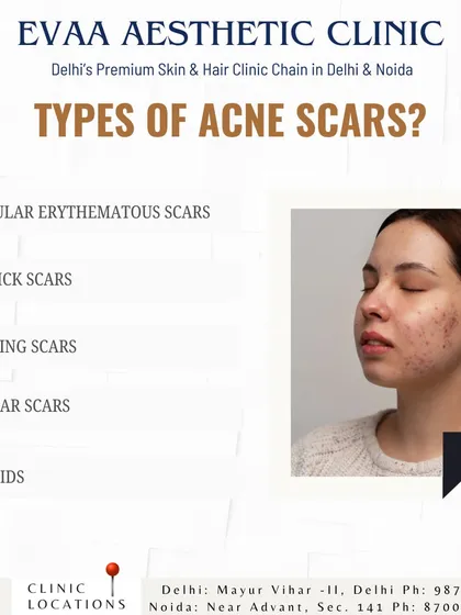 Understanding the type of acne scar is the first step to effective treatment. This infographic details various scar types, such as macular, ice pick, rolling, and boxcar scars.