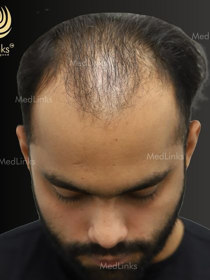 A top-down view of the patient's hair loss before the transplant.