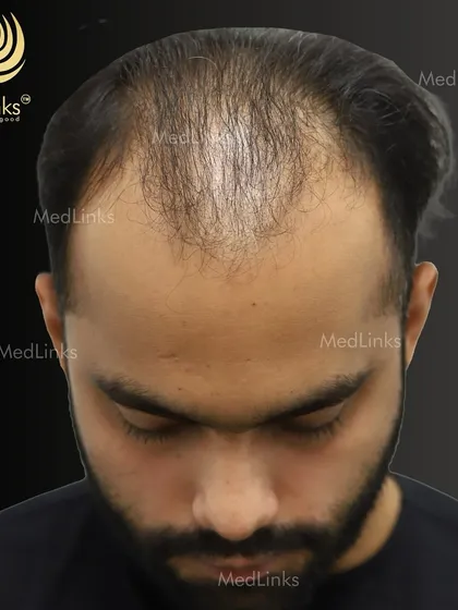 A top-down view of the patient's hair loss before the transplant.