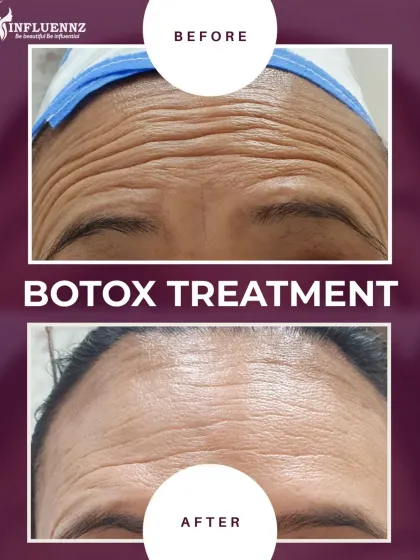 A dramatic reduction in deep-set forehead wrinkles after a Botox treatment. This shows how effective it can be for creating a smoother, more youthful appearance.
