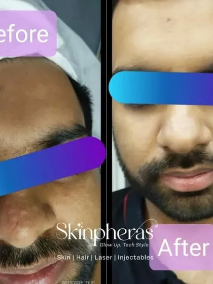 A fantastic before-and-after result from just one session of my Signature Facial Treatment. The improvement in skin tone, reduction in dullness, and overall radiant glow are clearly visible.