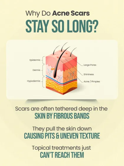 This diagram illustrates why acne scars are so persistent. They are often pulled down by fibrous bands deep in the skin, creating pits and an uneven texture that topical treatments simply cannot reach.