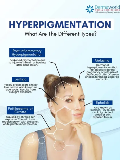 Hyperpigmentation comes in many forms, from post-acne marks (PIH) and melasma to sun-induced lentigo (age spots). Each type requires a different treatment strategy, which is why a correct diagnosis is so important.