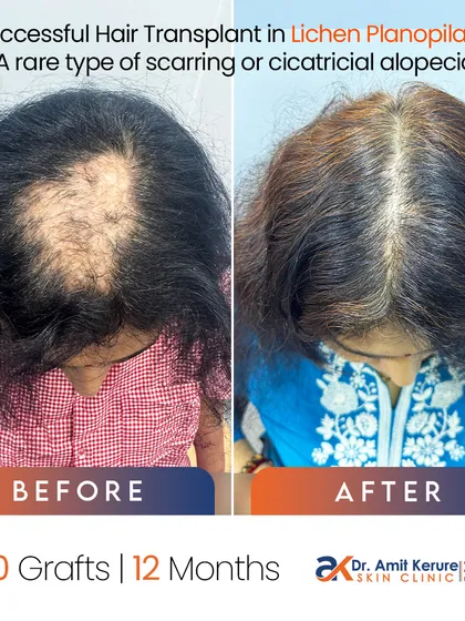 This case shows a successful hair transplant for a rare and challenging condition called Lichen Planopilaris, a type of scarring alopecia. It required 1800 grafts and 12 months to achieve this density, proving that even complex cases can be treated with proper diagnosis and timing.