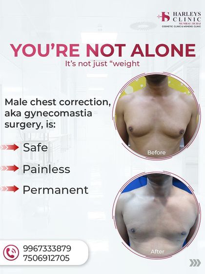 This image highlights the key benefits of male chest correction surgery. It is a safe, effective, and permanent solution for gynecomastia. The before and after photos show a clear reduction in chest protrusion, leading to a more defined physique.