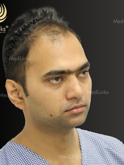 Here is a patient partway through his hair restoration journey. The clips hold back existing hair, preparing the scalp for the placement of new follicles that will restore density and confidence.