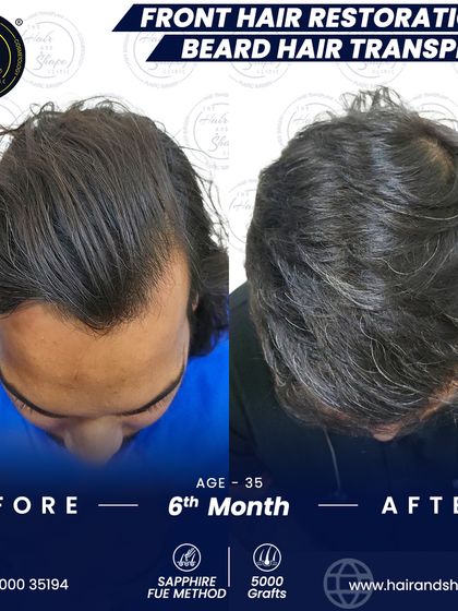 The top-down view highlights the successful hair restoration on the scalp, complementing the new beard.