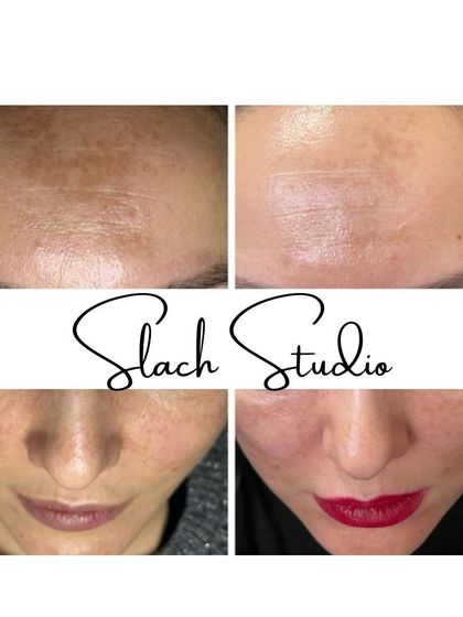 A fantastic result showing the clearing of pigmentation on the forehead and a brighter, more radiant complexion overall.
