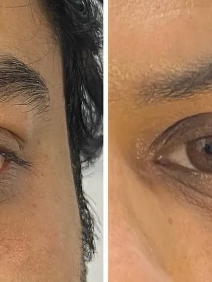 This close-up before-and-after shows a visible reduction in under-eye darkness and puffiness, resulting in a more refreshed appearance.