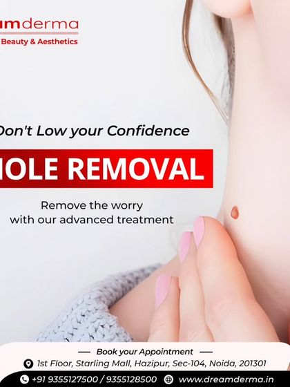 Don't let moles lower your confidence. Our advanced mole removal treatment is designed to remove the worry and the mole, leaving you with clearer skin and renewed self-assurance.