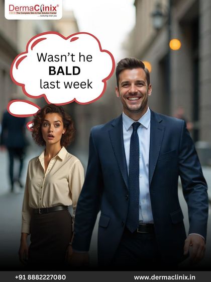 Our Long Hair FUE technique provides such instant results that it can leave people wondering, "Wasn't he bald last week?" This method allows you to resume your life, including work or social events, the very next day.