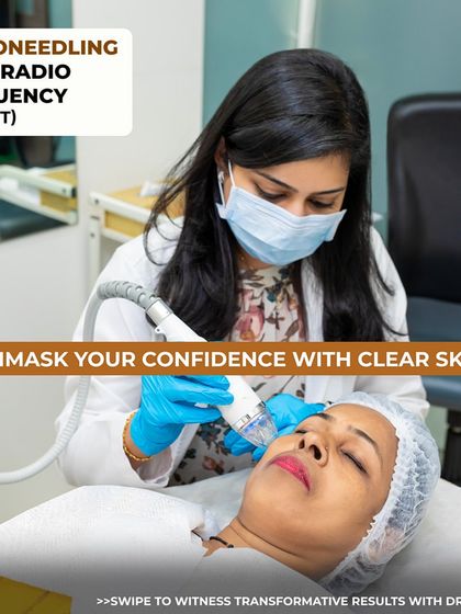 Here, our dermatologist performs the Secret Microneedling RF treatment, also known as Morpheus8. This procedure combines microneedling with radiofrequency energy to remodel collagen deep within the skin, making it highly effective for reducing acne scars and tightening the skin.