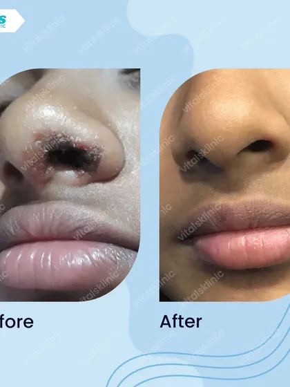 A successful removal of a lesion from the delicate area of the nose. This result showcases the careful technique required to achieve a clean aesthetic outcome while ensuring complete and safe removal.