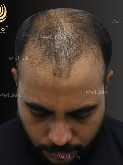 A top-down view of the patient's hair loss before the transplant.