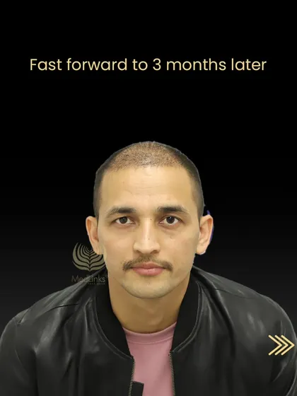 Three months after the procedure, Tika Ram's new hair is in the early growth phase.