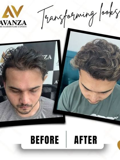 This client's new, fuller hairstyle is a result of our meticulous hair transplant procedure. We addressed the thinning at the front and top, creating a vibrant and healthy look.