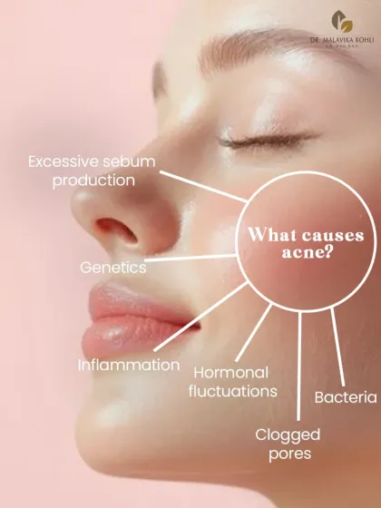 Acne is a complex inflammatory condition of the pilosebaceous unit. Its causes are multifactorial, including excess sebum production, bacterial proliferation, clogged pores (comedones), hormonal fluctuations, and inflammation. A successful treatment plan must address these root causes.