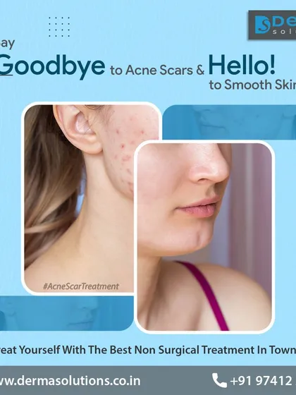 We specialize in transforming skin texture and reducing the appearance of acne scars. This visual represents the journey we take with our clients toward smoother, clearer skin.