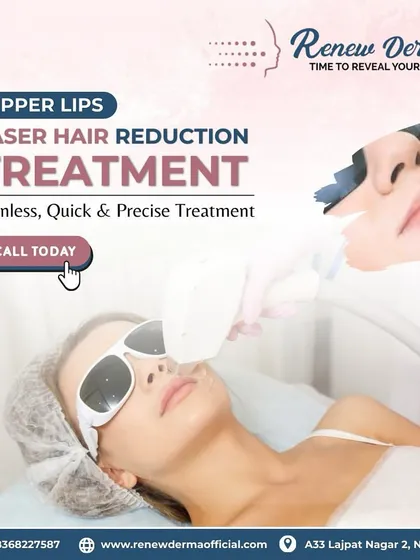 We offer precise treatments for smaller areas like the upper lips. This graphic shows a client getting upper lips laser hair reduction, a quick and effective way to remove unwanted facial hair without the pain of threading or waxing.
