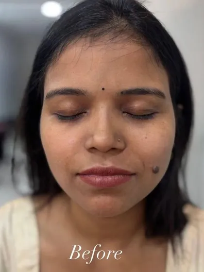 This is the 'before' photo for a client seeking a HydraFacial. Her skin appears a bit dull and is ready for a hydrating boost.