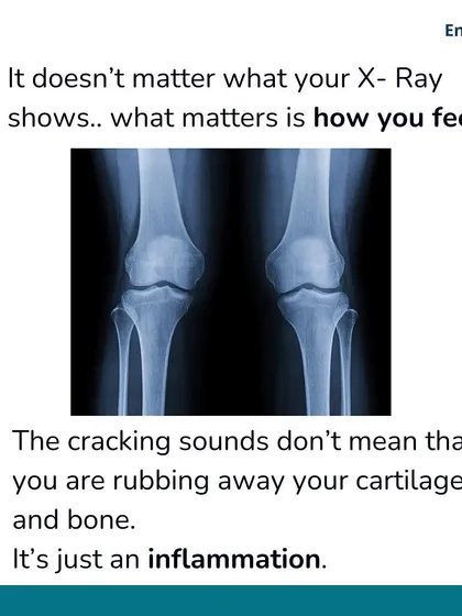 An X-ray showing joint space narrowing doesn't define your capabilities. What truly matters is how you feel and function. Cracking sounds don't mean your cartilage is rubbing away; it's often just a sign of inflammation, which we can manage with the right plan.
