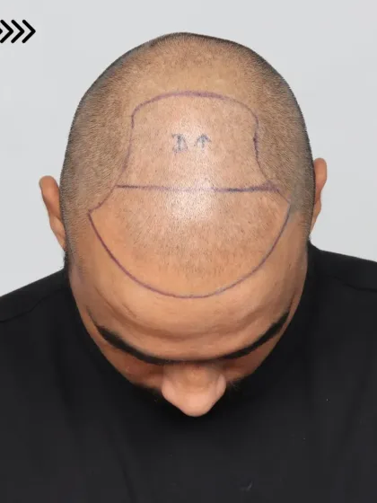 The process begins with precise planning. Here you can see the pre-marked area for a Grade 5A case before we implanted 3,800 grafts.