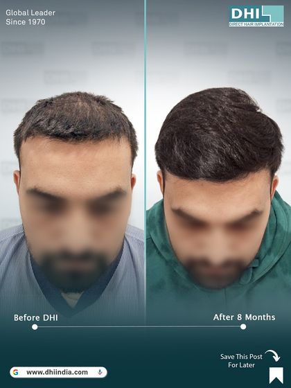 A frontal view of the patient 8 months after his procedure. While the focus was the crown, the overall improvement in his hair's appearance and his confidence is clearly visible.