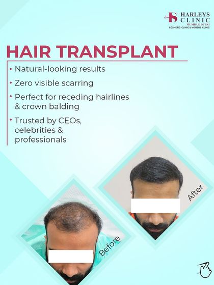 A before-and-after comparison showcasing a natural-looking result for a patient with a receding hairline and crown balding. My goal is to create results with zero visible scarring that are trusted by professionals.