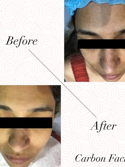 A fantastic before and after result from a Carbon Facial, showing instant radiance and a significant reduction in tanning and dullness.