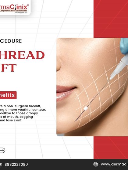An illustration of the thread lift procedure, a non-surgical facelift technique. This treatment restores a more youthful contour by lifting sagging jowls and skin around the mouth.