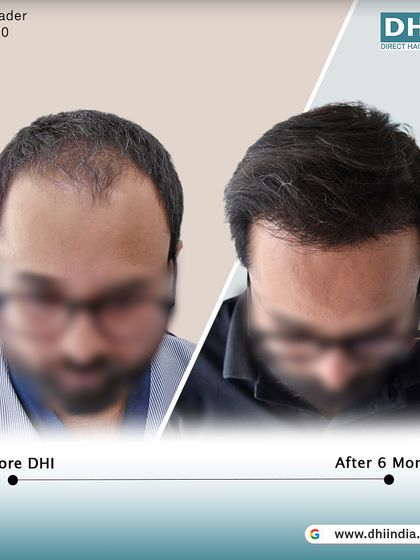 A top-down view of the same client's 6-month progress. This image clearly shows the new growth and increased density, demonstrating the powerful results of our DHI hair transplant.