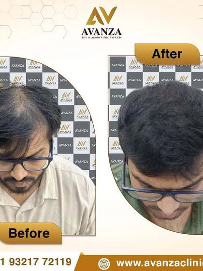 A clear before and after comparison showing the successful restoration of hair density and a natural-looking hairline. Confidence restored.