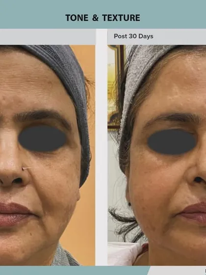 Notice the brighter under-eye area and the softening of facial lines. ADVA Tx rejuvenates the entire face for a holistic and natural-looking enhancement.