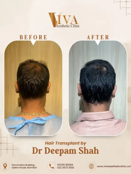 The back view of the same patient shows how we addressed the thinning crown area. The result is comprehensive coverage from front to back.