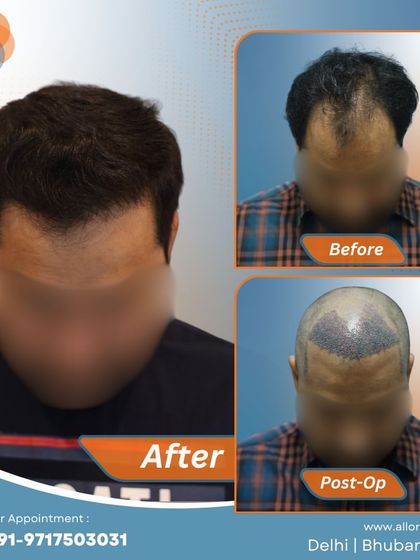 This series shows the complete process for a patient, from the before and post-op stages to the final impressive result. It gives a comprehensive view of the transformation journey.