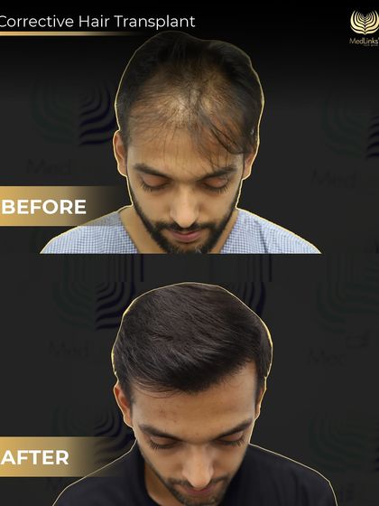 A top-down view of the corrective procedure. The 'before' shows sparse and poorly placed grafts. The 'after' shows how we achieved even density and natural coverage across the scalp.