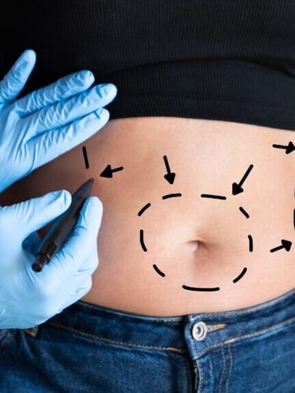 Before any liposuction procedure, I carefully mark the treatment areas. This ensures precision in fat removal and helps in sculpting the desired body contour.