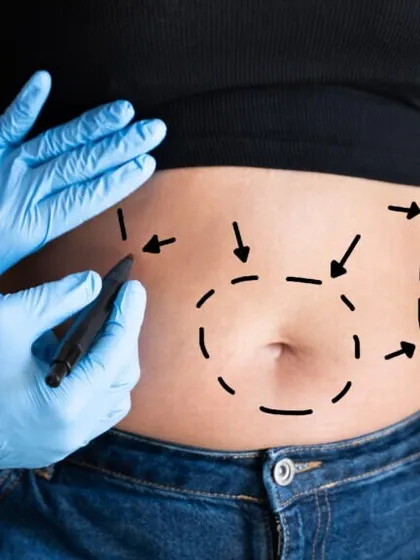 Before any liposuction procedure, I carefully mark the treatment areas. This ensures precision in fat removal and helps in sculpting the desired body contour.